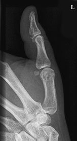Normal Antero-posterior (AP) radiografie de Police