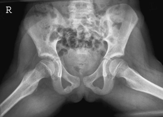 Normal radiografie evidențiind ambele hips în Profil (lateral) incidență (frog membre inferioare)