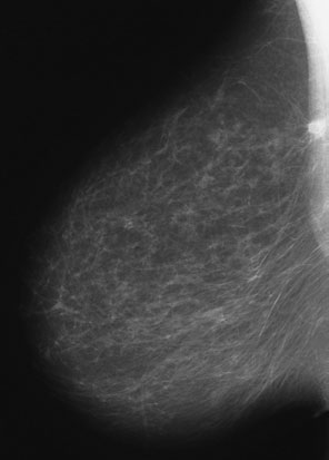 • If toate Sân (Mamografie) tissue este nu seen, then radiographer’s