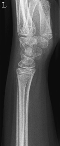 Normal Profil (lateral) radiografie