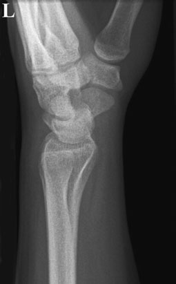 Postero-anterior (PA) radiografie de
