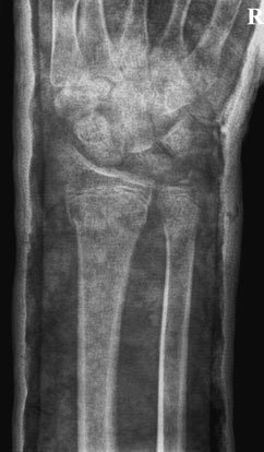 Postero-anterior (PA) radiografie de Pumn (Articulație Radiocarpiană)