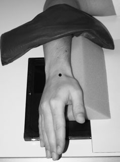 • suspiciune de fractură de distal radius poate fie undisplaced, dorsally