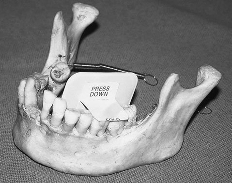 Radiografie dentară bitewing (interproximală)