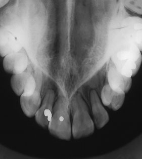 10 Radiografie dentară ocluzală