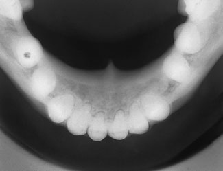 10 Radiografie dentară ocluzală
