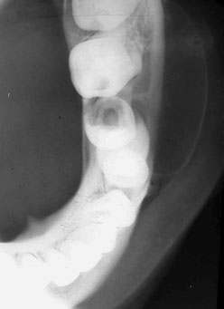 identificarea eficientă a fragmentelor dentare suspectate a fi fracturate și radioopace pentru-