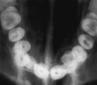 Radiografie dentară ocluzală