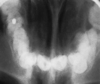 radiografie ocluzală de vertex evidențiind caninul stâng poziționat vestibular