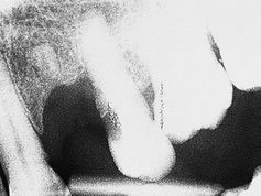 Radiografie Dentară Retroalveolară (Periapicală)