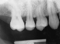 radiografia maxilarului superior stâng arată blocul de ocluzie prins