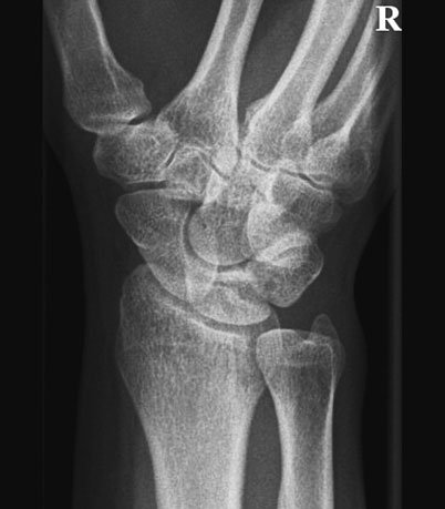 Normal Oblică Anterioară radiografie de Scafoid Carpian