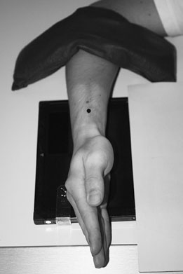 • suspiciune de fractură de waist de Scafoid Carpian poate fie very poorly vis-