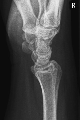 Profil (lateral) radiografie de Pumn (Articulație Radiocarpiană)