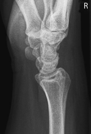 Normal Profil (lateral) radiografie de Pumn (Articulație Radiocarpiană)