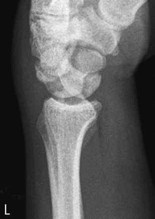 Profil (lateral) radiografie de Pumn (Articulație Radiocarpiană) evidențiind luxație articulară de lunate. lunate