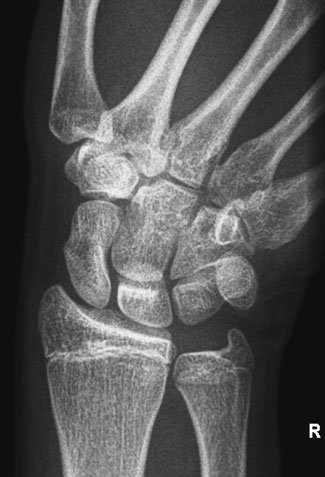 Antero-posterior (AP) radiografie de Pumn (Articulație Radiocarpiană)