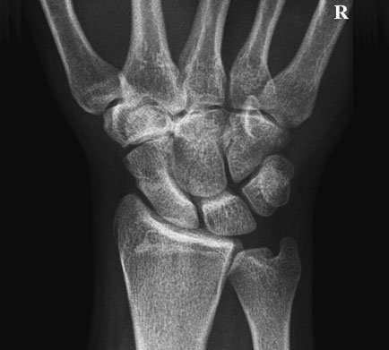 Normal Postero-anterior (PA) radiografie de Scafoid Carpian în Deviație Ulnară