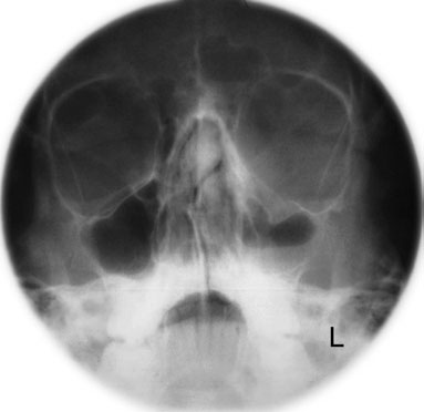 PNS radiografie este usually performed pe children între four