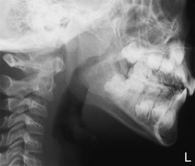 evidențiind blowout suspiciune de fractură de stâng inferior orbital margin cu lichid