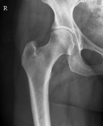Antero-posterior (AP) radiografie de single Șold evidențiind pin și plate în situ