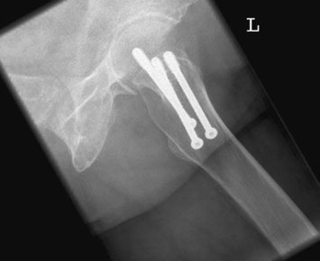 Oblică Posterioară incidență evidențiind poziție de Garden screws