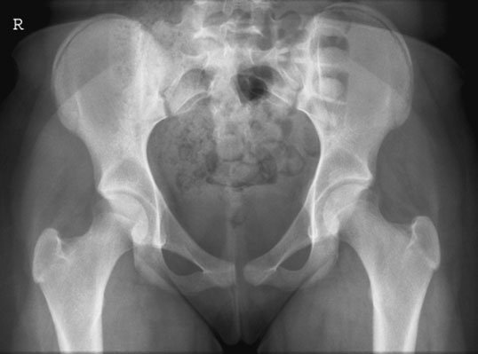 tal Bazin (bazin (pelvis)) este nu missed, e.g. suspiciune de fracturăd pubic ramus.
