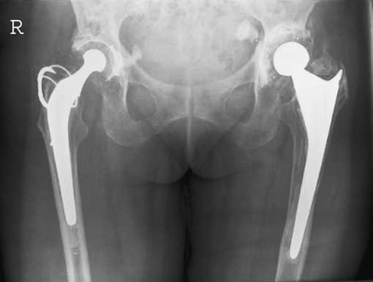 în cases de suspected suspiciune de fractură de Șold, injured limb este