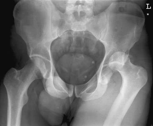 Antero-posterior (AP) Bazin (bazin (pelvis)) evidențiind suspiciune de fractură de ischium și pubis cu disruption