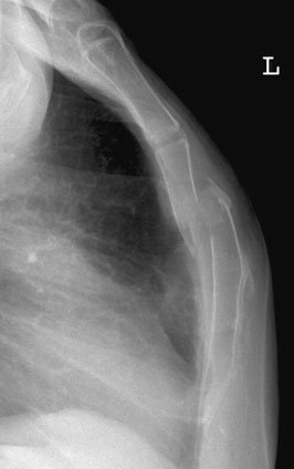 Radiografie normală de profil (lateral) a sternului