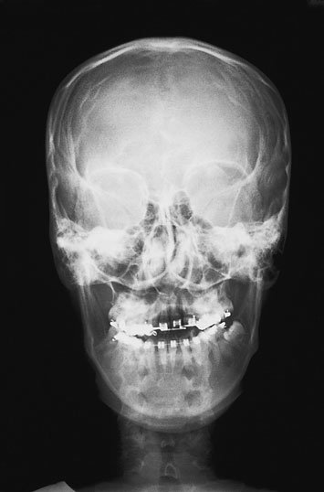 Figura 1: Aspect radiografic / Poziționare (Clark Ed. 12)