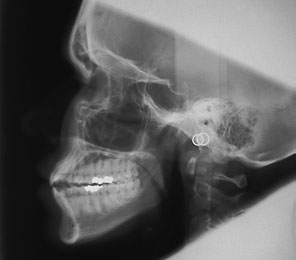 Radiografie cefalometrică adevărată de profil (laterală) a craniului cu imagini ale tijelor metalice auriculare