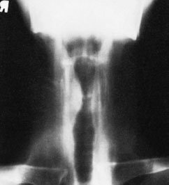 Figura 3: Aspect radiografic / Poziționare (Clark Ed. 12)