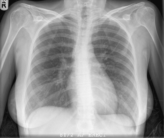 • radiografie opposite este de similar appearance la that de