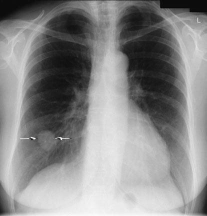 Postero-anterior (PA) și Profil (lateral) radiografii de same pacient evidențiind proces proliferativ tumoral în