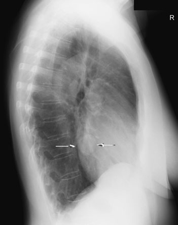 Figura 6: Aspect radiografic / Poziționare (Clark Ed. 12)