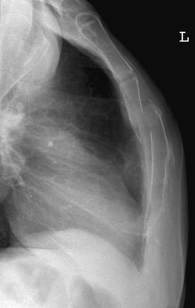 Profil (lateral) incidență de upper anterior chest în pacient cu sternal suspiciune de fractură