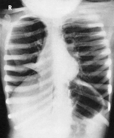 Lordotică Postero-anterior (PA) radiografie evidențiind middle lobe collapse