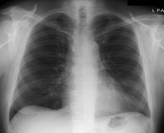 ideal Postero-anterior (PA) chest radiografie trebuie să evidențiază
