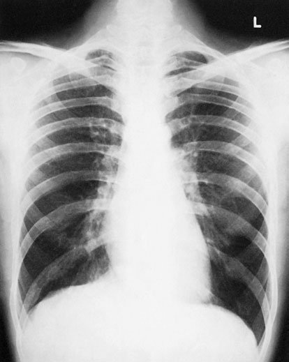 could mimic pleural lichid sau even pneumotorax. Creasing de