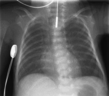 • Overexposure de neonatal chest radiografii results în loss de