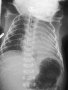 imagine de correctly poziționat normal neonatal chest radiografie