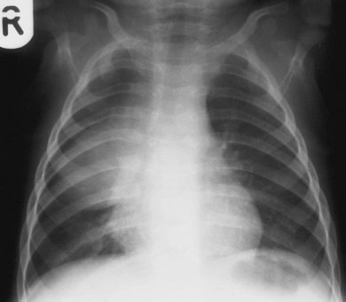 radiografie cu excessive lordosis de toracele, rib ends appear la