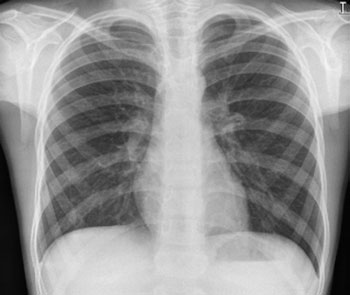 • Correct interpretation de paediatric chest radiografii requires