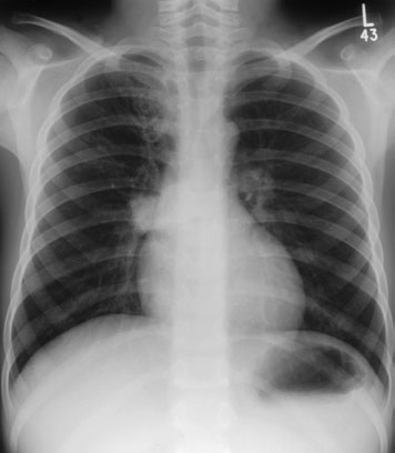 tilting. radiographer trebuie să watch child’s chest/