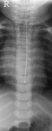 • Incorrect densitate optică – needs radiographer experience în assess-