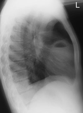 Profil (lateral) chest radiografie evidențiind pulmonary abscess și nivele hidroaerice