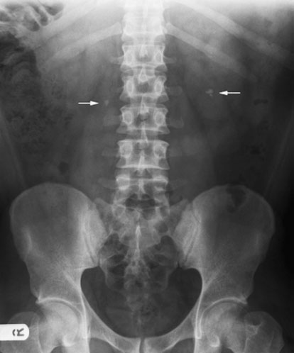 parenchim renal. O radiografie suplimentară efectuată în apnee