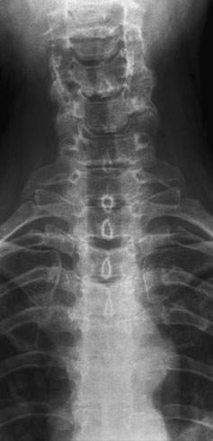 și la bring radiographic baseline la angle de 20 grade