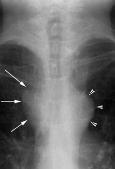 Antero-posterior (AP) radiografie evidențiind normal trachea